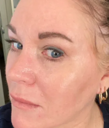 a woman's cheek without acne